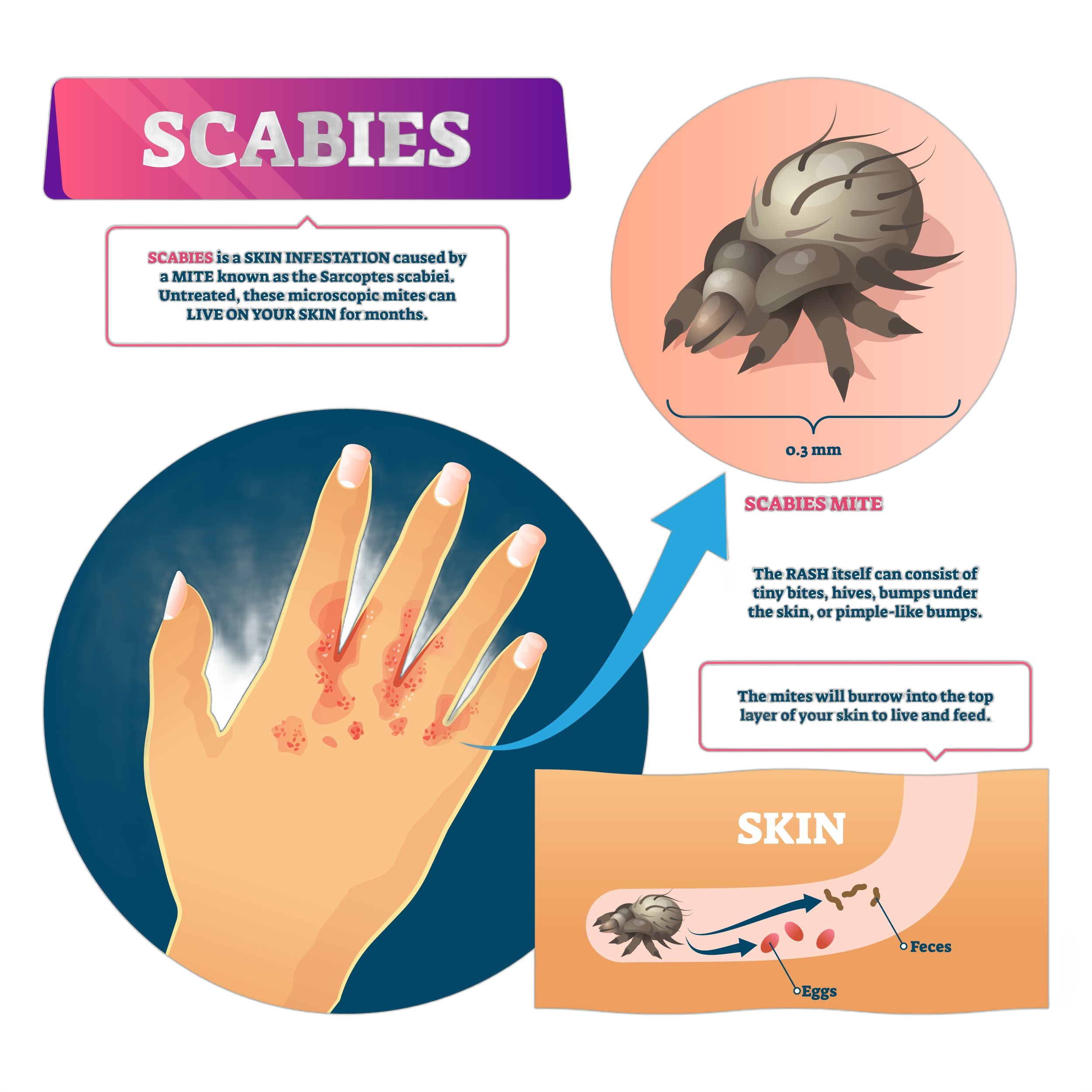 Scabies explained courierstaging.mystagingwebsite.com